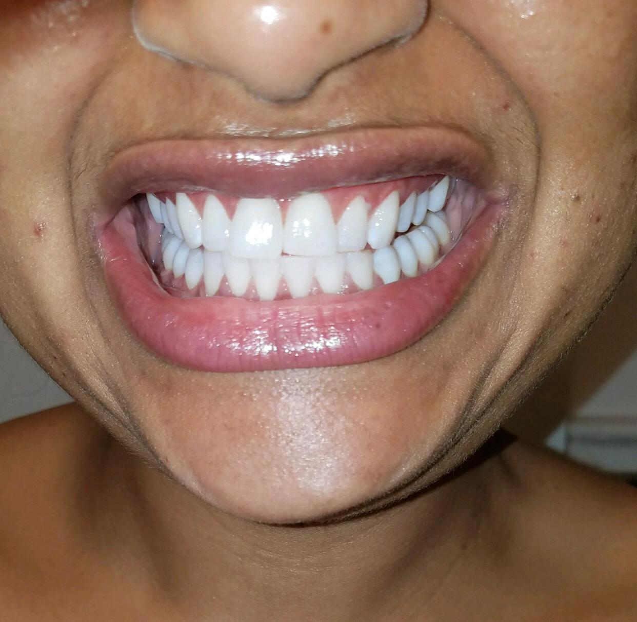 Kit de blanqueamiento dental