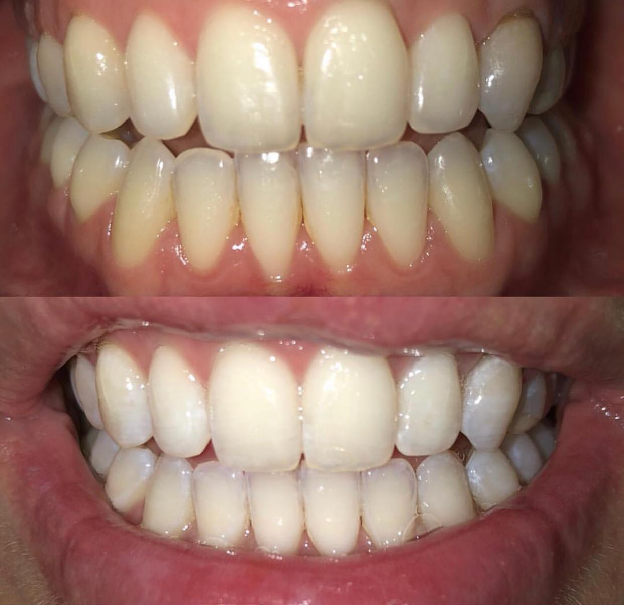 Kit de blanqueamiento dental