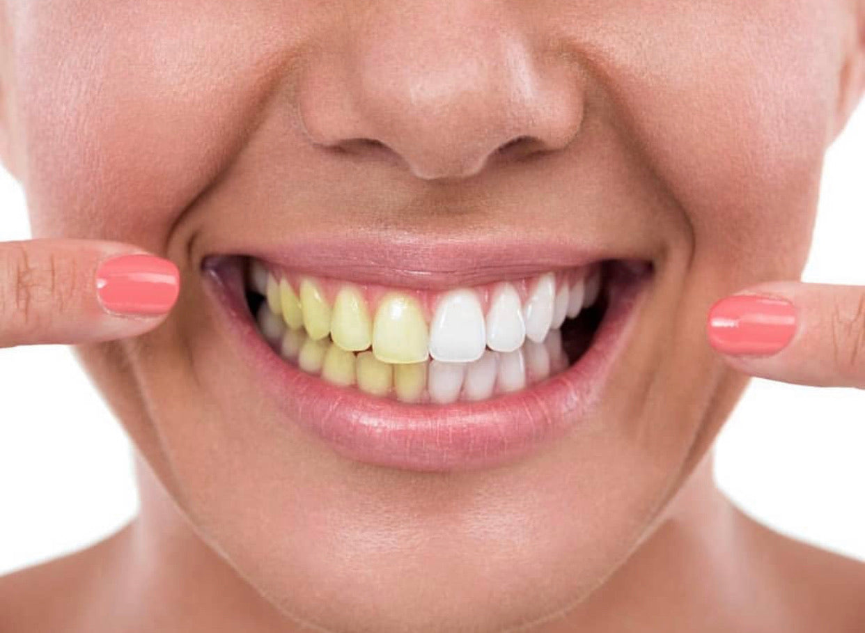 Kit de blanqueamiento dental